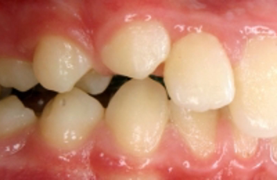 Croppedimage330130 Prominent Teeth Profile B4